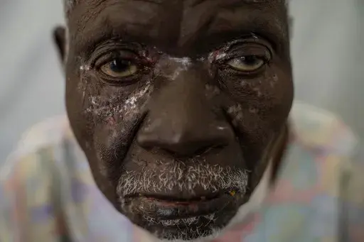 Christophe Chavilinga, 90, suffering from mpox, waits for treatment at a clinic in Munigi, eastern Congo, Friday, Aug. 16, 2024. (AP Photo/Moses Sawasawa)