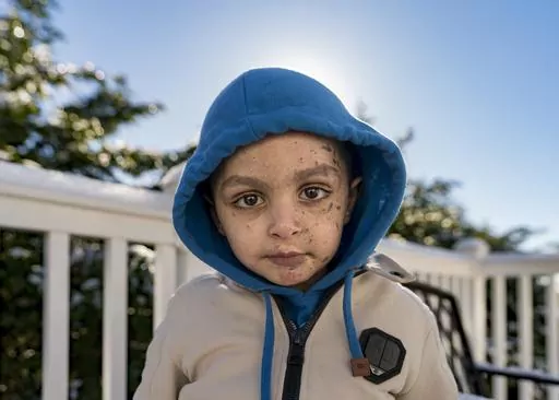 Omar Abu Kuwaik poses for a photo at the Global Medical Relief Fund residence, Wednesday, Jan. 17, 2024, in the Staten Island borough of New York. On Dec. 6, 2023 two Israeli airstrikes slammed into Omar's grandparents' home in the Nuseirat refugee camp, in central Gaza. The explosion peeled the skin from his face, exposing raw pink layers peppered with deep lacerations. His left arm could not be saved below the elbow. His parents, 6-year-old sister, grandparents, two aunts and a cousin were kil