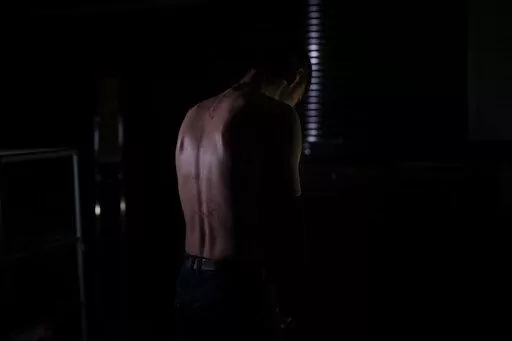 In this Nov. 23, 2022 photo, Igor shows the remains of marks on his back after allegedly being tortured by Russian forces in Kherson. The 22-year-old, accused of providing Ukrainians with Russia's military positions, was stung with a taser along his back for two and half hours and then forced to stay awake, seated in a chair all night. He was freed after two days but not before writing a letter providing details about a relative of his uncle's who the Russians wanted information on. (AP Photo/Be