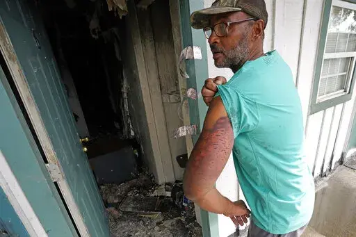 Shooting survivor Michael James shows his shotgun wounds while standing outside his fire-damaged apartment, Monday, Aug. 29, 2022, in Houston. Houston police say a man evicted from an apartment set fire to the building early Sunday to lure out other tenants, then fatally shot three and wounded two others, including James. (AP Photo/David J. Phillip)
